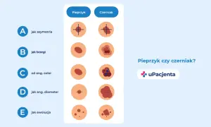 Porównanie cech pieprzyka i czerniaka: asymetria, brzegi, kolor, średnica i ewolucja.