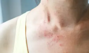Czerwone, swędzące plamy na szyi i dekolcie wskazują na **alergia skórna**.