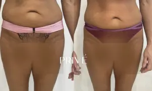 Endermologia: Bezinwazyjne modelowanie sylwetki co musisz wiedzieć?