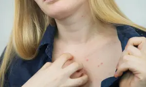 Skóra na dekolcie i szyi z czerwonymi krostkami, sugerującymi swierzb. Kobieta drapie się po swędzącym miejscu.