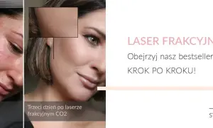 Laser frakcyjny: Jak szybko goić skórę? Poradnik krok po kroku