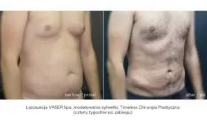 Liposukcja: Skuteczne modelowanie sylwetki co musisz wiedzieć?