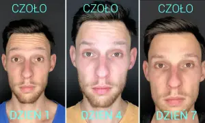 Ile kosztuje botoks na twarz? Pełny cennik i co wpływa na cenę