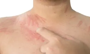 Czerwone pręgi na skórze, wynikające z dermografizmu, są widoczne na szyi i klatce piersiowej.