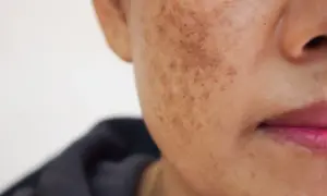 Skóra z przebarwieniami, widoczne plamy melasma na policzku.