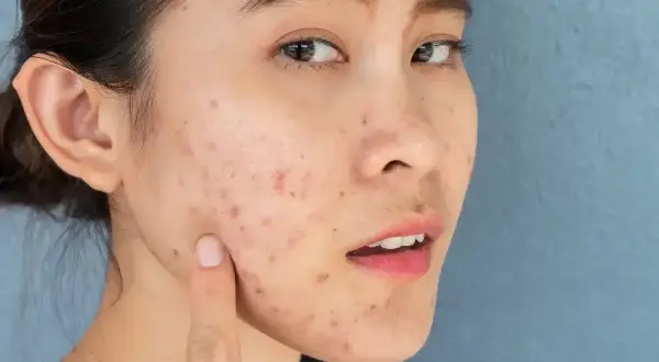 Młoda kobieta z widocznymi zmianami skórnymi na twarzy, wskazującymi na **grzybica skóry początki**.