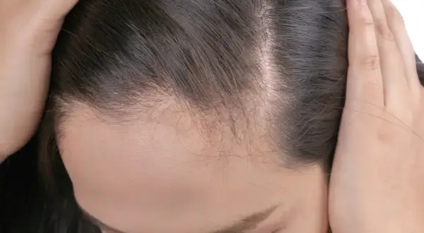 Widoczne przerzedzenie włosów na skroniach i czole. Czy to alopecia? Zastanawiasz się, alopecia co to jest i jak sobie z tym radzić?