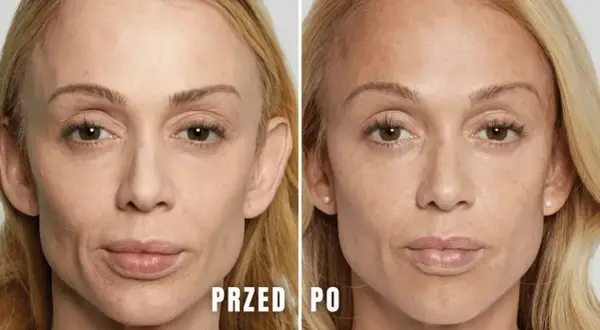 Przed i po zabiegu: skóra pod oczami wygładzona, zmarszczki zredukowane dzięki kwasowi polimlekowemu.