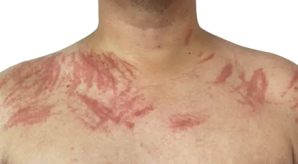 Skóra klatki piersiowej i szyi z czerwonymi, prążkowanymi zmianami, przypominającymi ślady po drapaniu. To objawy pokrzywki dermograficznej.