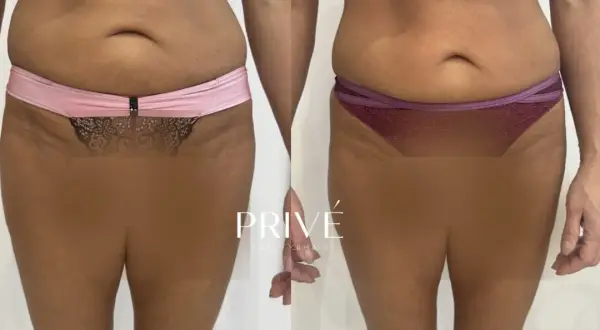 Endermologia: Bezinwazyjne modelowanie sylwetki co musisz wiedzieć?