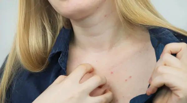 Skóra na dekolcie i szyi z czerwonymi krostkami, sugerującymi swierzb. Kobieta drapie się po swędzącym miejscu.