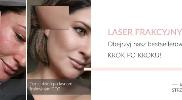 Laser frakcyjny: Jak szybko goić skórę? Poradnik krok po kroku