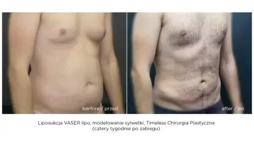 Liposukcja: Skuteczne modelowanie sylwetki co musisz wiedzieć?