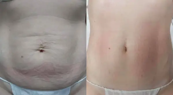 Przed i po zabiegu: widoczne wygładzenie skóry brzucha, redukcja zmarszczek i poprawa napięcia. Endermologia brzuch efekty zachwycają!