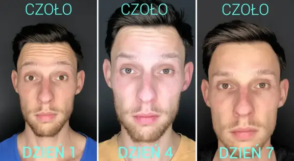 Ile kosztuje botoks na twarz? Pełny cennik i co wpływa na cenę