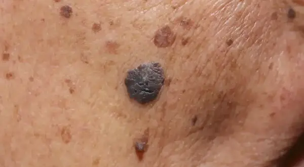 Zbliżenie na skórę z licznymi przebarwieniami i ciemniejszymi znamionami, w tym jednym większym, przypominającym brodawkę. Widoczne suche plamy na twarzy.