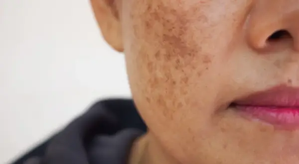 Skóra z przebarwieniami, widoczne plamy melasma na policzku.