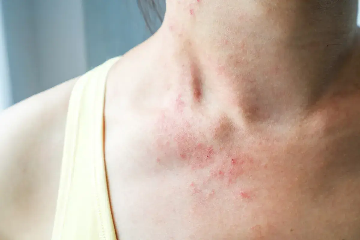 Czerwone, swędzące plamy na szyi i dekolcie wskazują na **alergia skórna**.
