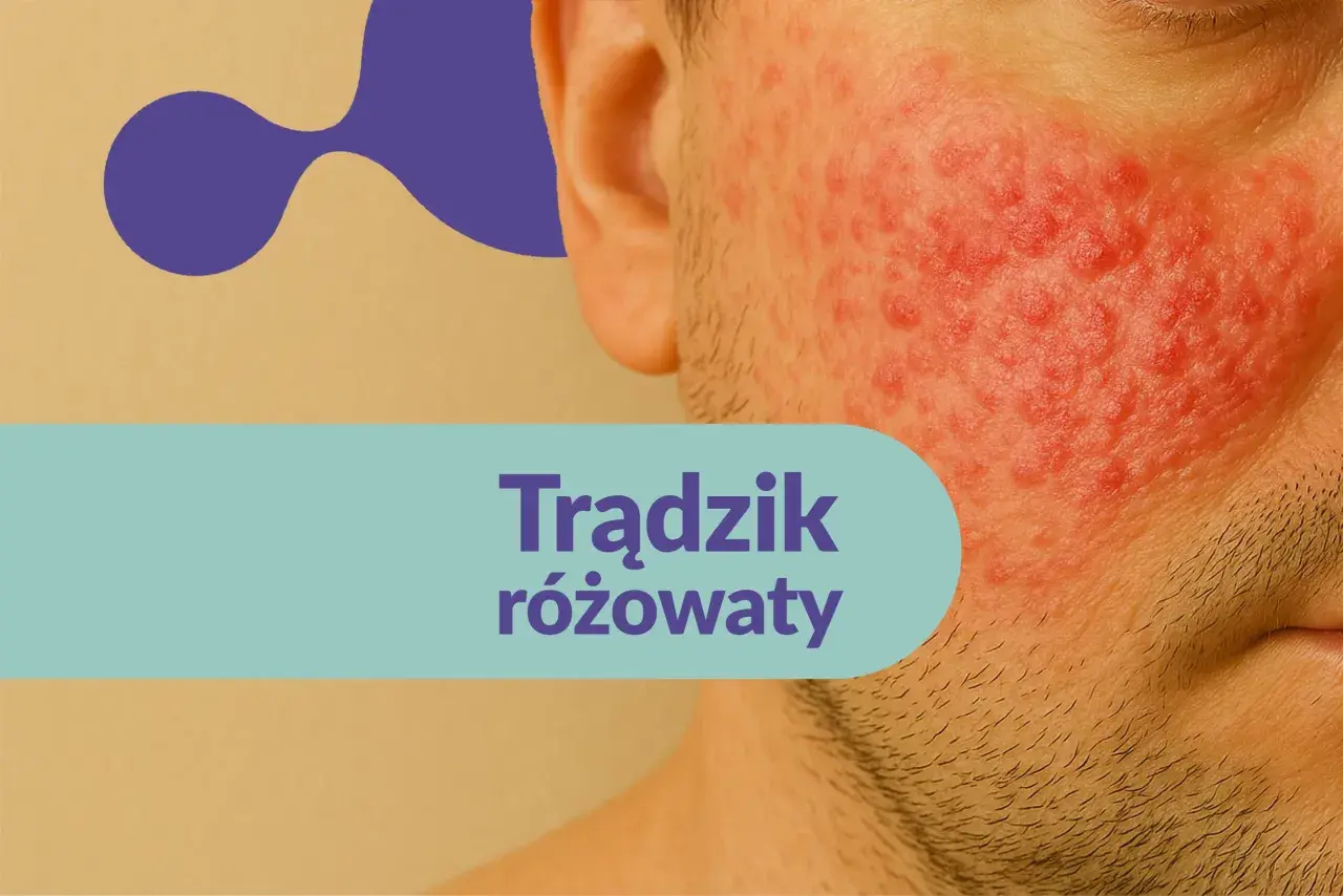 Skóra mężczyzny z widocznym trądzikiem różowatym na policzku. Czerwone, zapalne zmiany skórne.