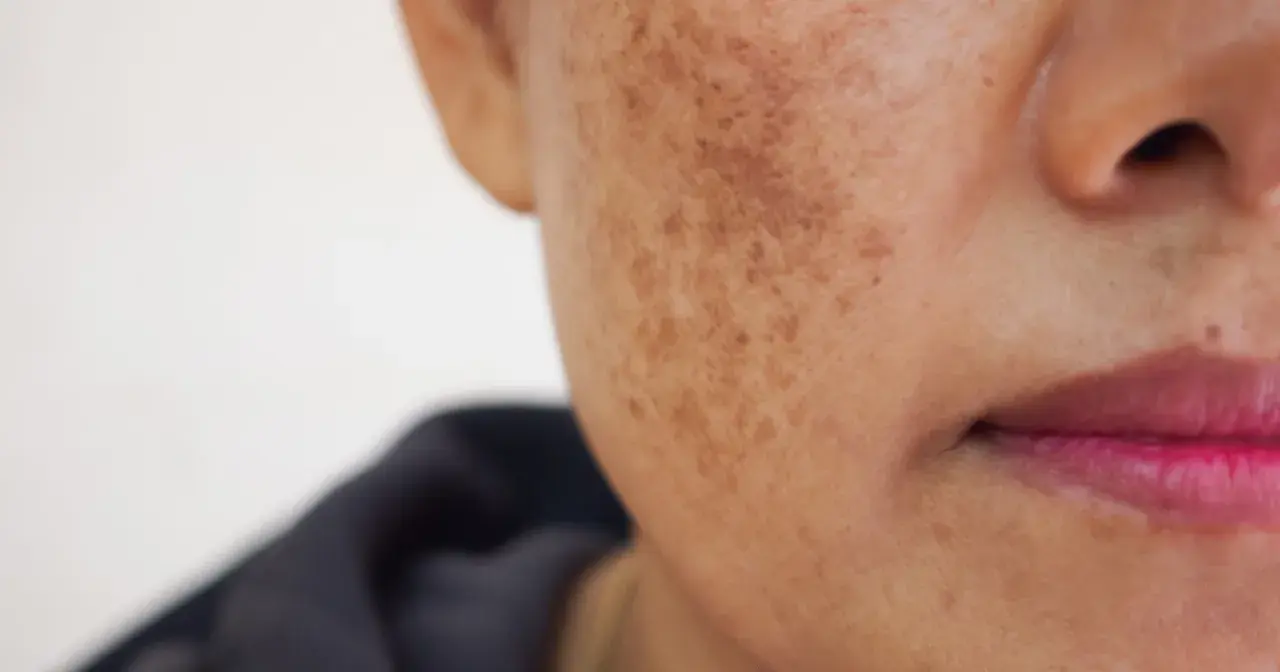Skóra z przebarwieniami, widoczne plamy melasma na policzku.