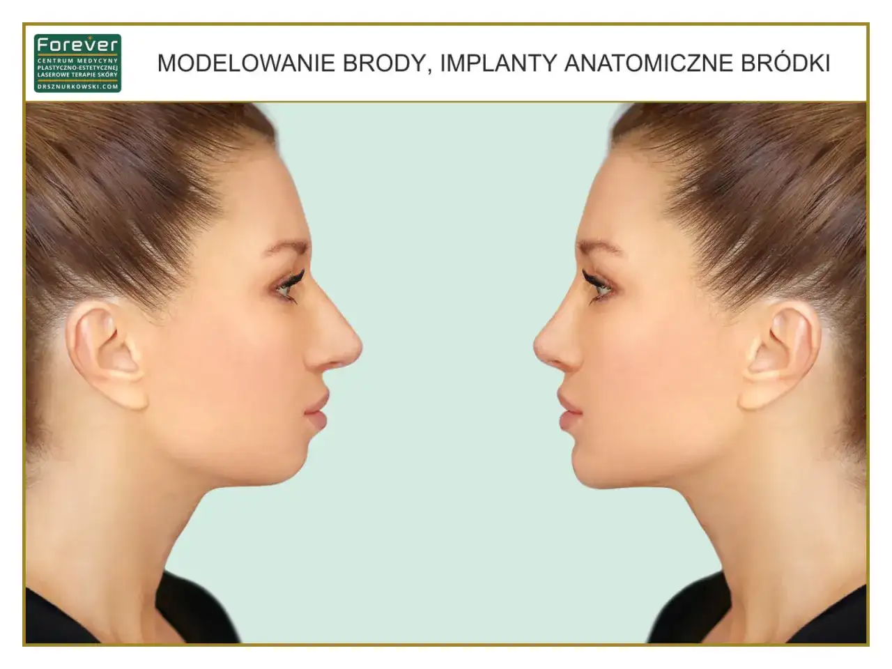 Modelowanie brody: porównanie profilu twarzy przed i po zabiegu. Widoczne zmiany w linii żuchwy i podbródka.