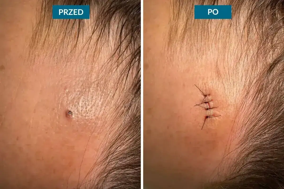 Przed i po usunięciu pieprzyka na czole. Zastanawiasz się, ile kosztuje usunięcie pieprzyka? Widzisz efekt zabiegu.