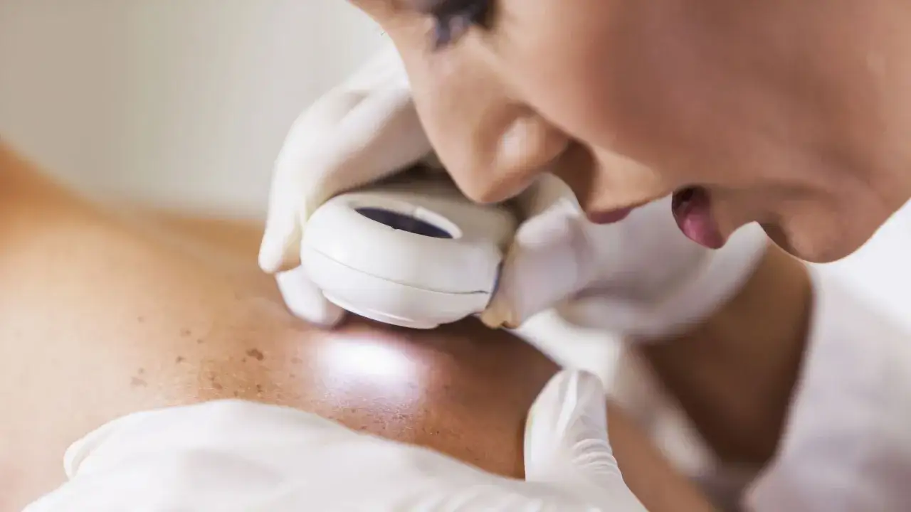 Dermatolog bada skórę z przebarwieniami, być może melasma, za pomocą dermatoskopu.